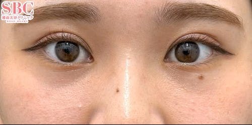 【20代女性・目元】裏ハムラ法 ナチュラル脂肪注射ナノリッチ VOV（ボブ）リフト_aftar