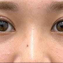 【20代女性・目元】裏ハムラ法 ナチュラル脂肪注射ナノリッチ VOV(ボブ)リフト_aftar