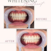【20代女性・歯】ポリリンホワイトニング_before_aftar
