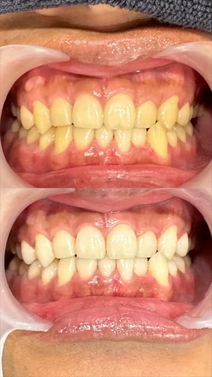 【歯】オフィスホワイトニング_before_aftar