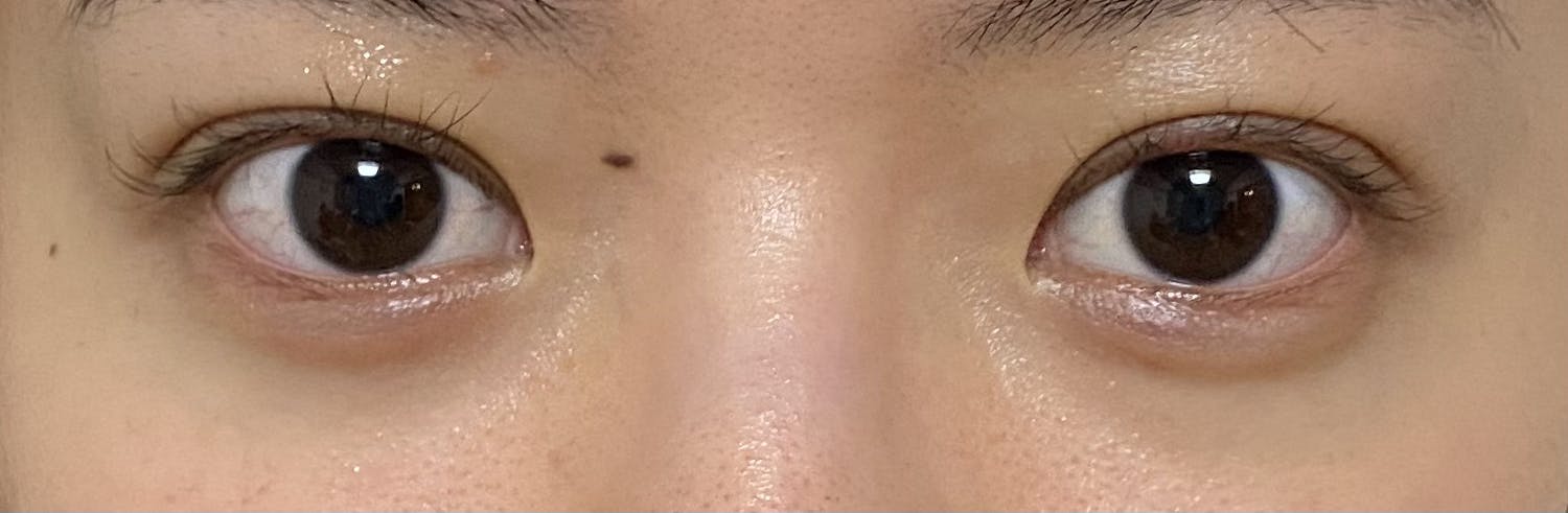 L’or Clinic Omotesando 表参道院(ロールクリニックオモテサンドウ)でを受けたちょもさんの写真