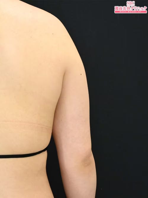 【20代女性・二の腕】クールスカルプティング(R)・ エリート（クルスカダブル） サクセンダ_before