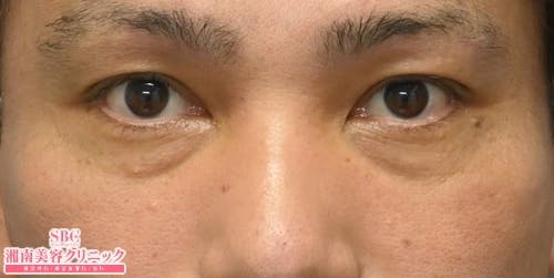 【40代男性・目元】目の下の切らないクマ・たるみ（ふくらみ）取り ナチュラル脂肪注射コンデンスリッチ ナチュラル脂肪注射ナノリッチ_before