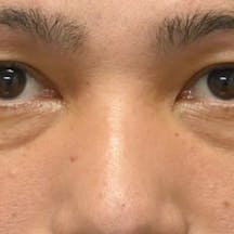 【40代男性・目元】目の下の切らないクマ・たるみ(ふくらみ)取り ナチュラル脂肪注射コンデンスリッチ ナチュラル脂肪注射ナノリッチ_before