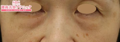 【女性・目元】ナチュラル脂肪注射コンデンスリッチ、目の下の切らないクマ・たるみ（ふくらみ）取り_before