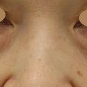 【女性・目元】ナチュラル脂肪注射コンデンスリッチ、目の下の切らないクマ・たるみ(ふくらみ)取り_before