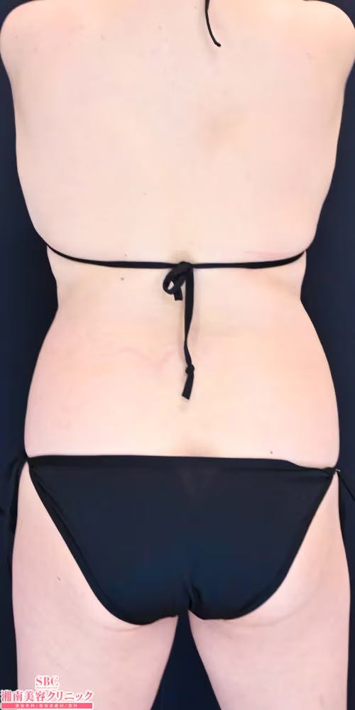 【50代女性・腹部】トゥルースカルプiD サクセンダ_after