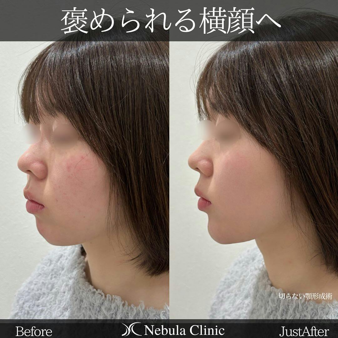 【女性・顎】切らない顎形成術_before_aftar