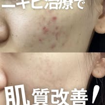 【女性・ニキビ】ケミカルピーリング・クロモライト_before_aftar