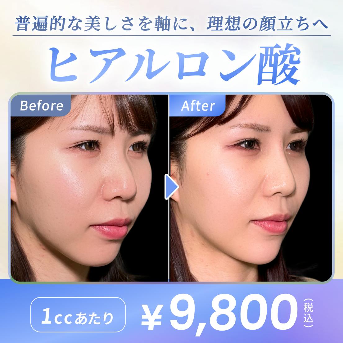 ヒアルロン酸注射の画像