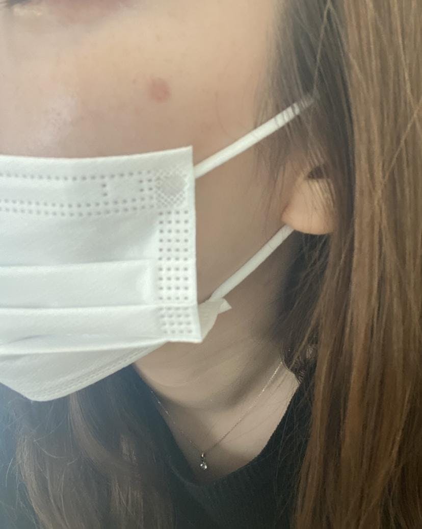 にしたんクリニック 渋谷院でピコスポットを受けたあちゃんさんの写真