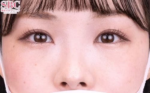 【20代女性・目元】ナチュラル脂肪注射コンデンスリッチ、目の下の切らないクマ・たるみ（ふくらみ）取り_1week