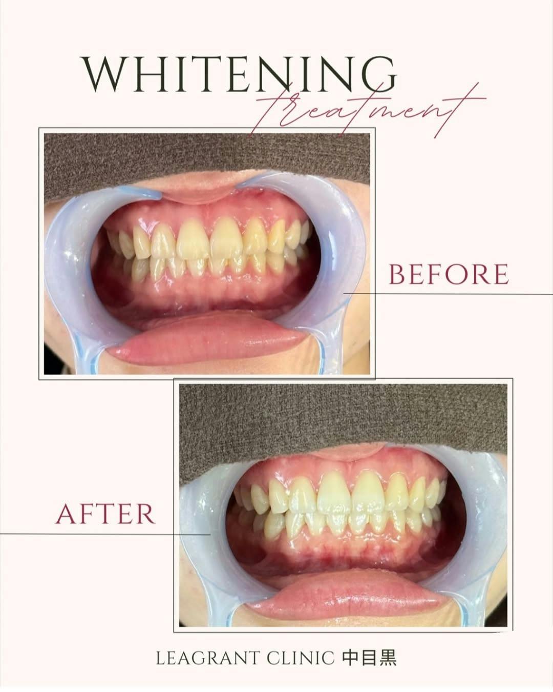 【20代女性・歯】ポリリンホワイトニング_before_aftar