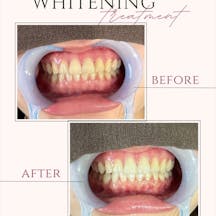 【20代女性・歯】ポリリンホワイトニング_before_aftar