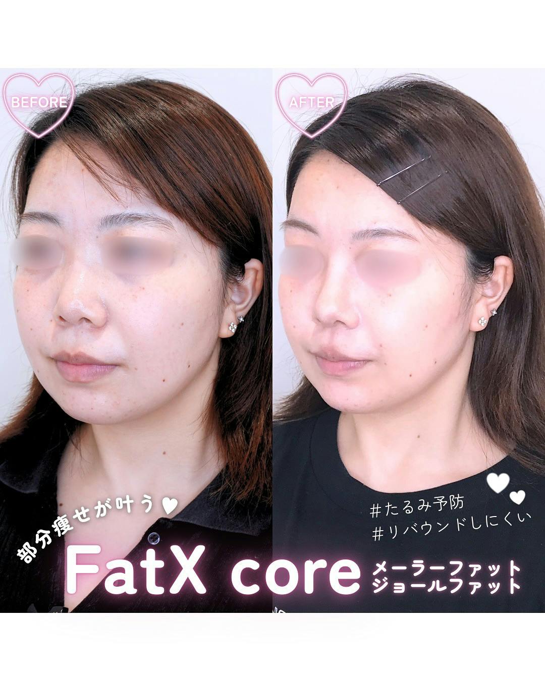 【女性・顔】FatX core メーラーファット・ジョールファット_before_aftar