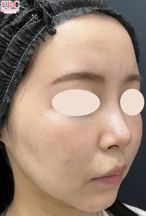 【女性・顎】ヒアルロン酸_before