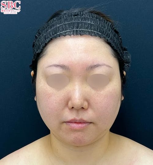 【30代女性・顔】Aquicell(アキーセル)脂肪吸引(頬・顎下)・ジョールファット除去術・メーラーファット・バッカルファット・糸リフト・エンブレイスRF・脂肪注入(顎先)_before