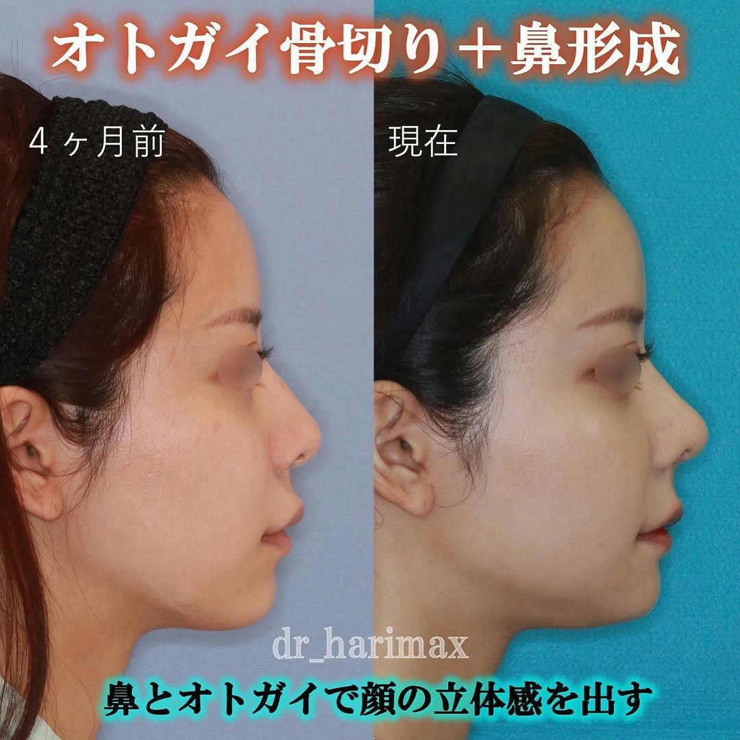 【女性・顎・鼻】オトガイ骨切り・鼻修正_before_aftar