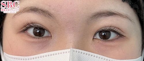 【女性・目元】線留めクロス二重術_aftar