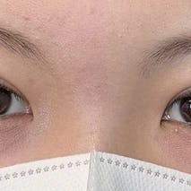 【女性・目元】線留めクロス二重術_aftar