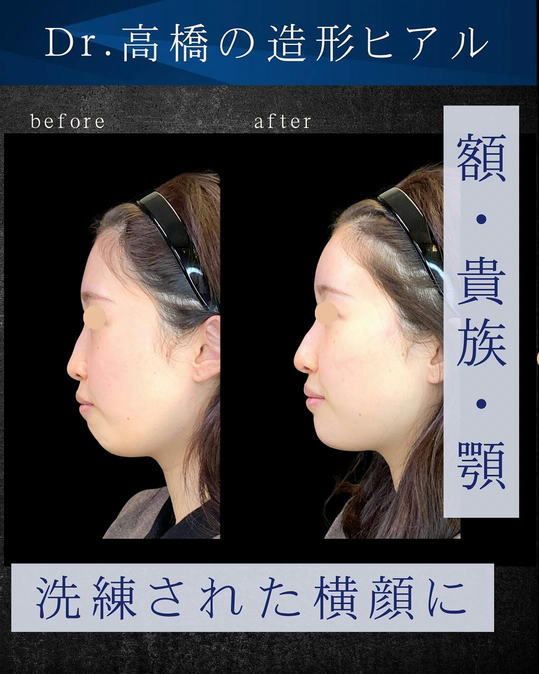 【女性・輪郭】ヒアルロン酸_before_aftar