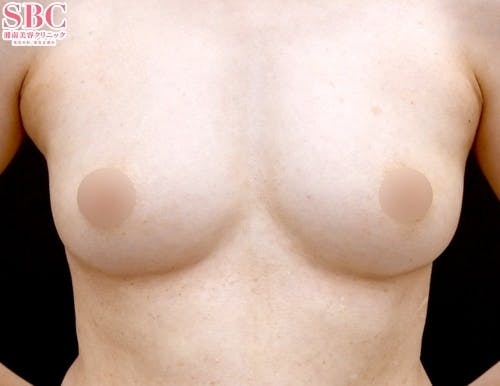 【40代女性・胸】Aquicell（アキーセル）併用セルーション(脂肪注入豊胸)_aftar