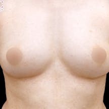 【40代女性・胸】Aquicell(アキーセル)併用セルーション(脂肪注入豊胸)_aftar