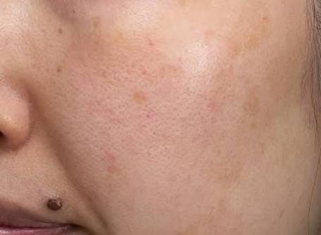 渋谷美容外科クリニック 渋谷院で医療レーザー脱毛（女性パーツプラン）：顔全体 5回を受けたやまちゃんさんの写真