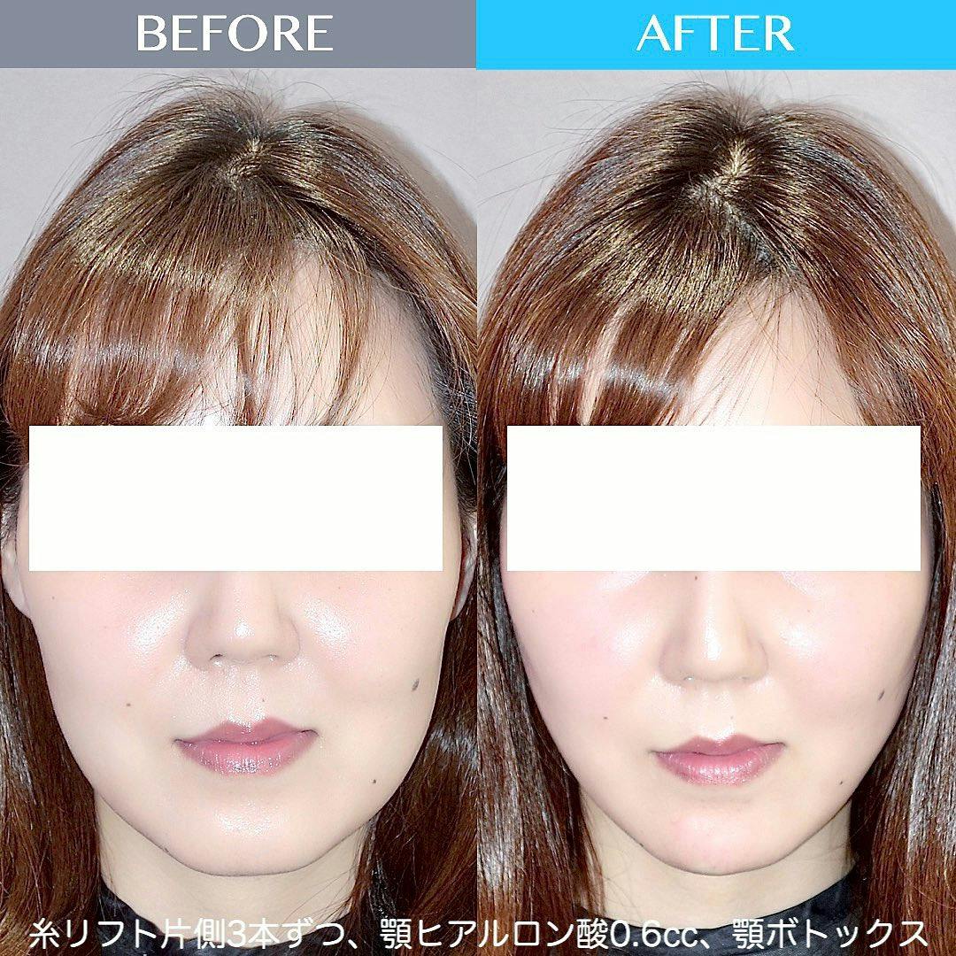 【女性・輪郭】糸リフト、あごヒアルロン酸、ボトックス_before_aftar