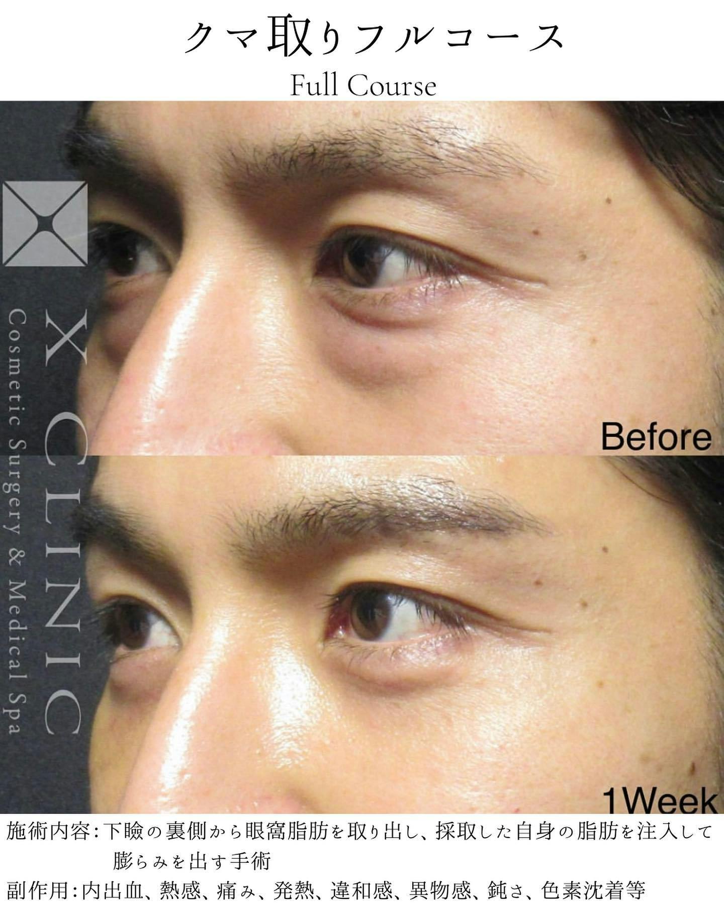【男性・目元】クマ取りフルコース_before_aftar