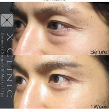 【男性・目元】クマ取りフルコース_before_aftar