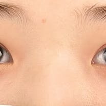 【20代女性・目元】線留めクロス二重術、自然癒着法_after
