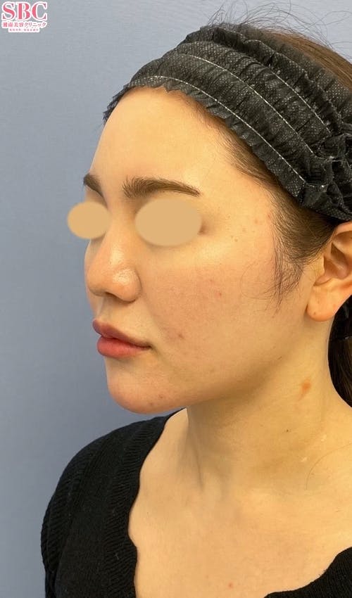 【女性・輪郭】Aquicell（アキーセル）脂肪吸引、メーラーファット除去術、ジョールファット除去術_aftar