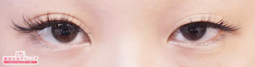 【女性・目元】クイックコスメティーク・シングルNeo、クイックコスメティーク・ダブルNeo、埋没法二重術クイックコスメティーク法_before