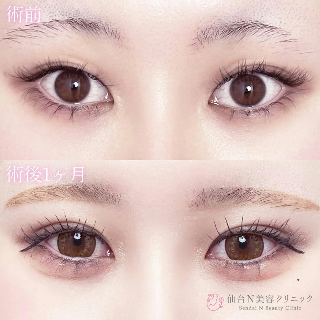 【女性・目元】二重埋没法（シークレットトリプル）_before_aftar