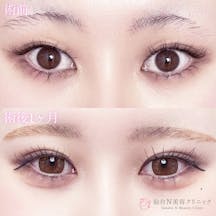 【女性・目元】二重埋没法(シークレットトリプル)_before_aftar