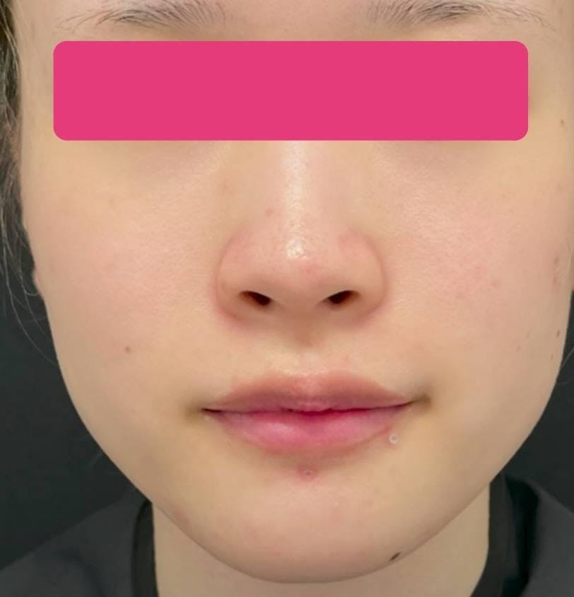 湘南美容クリニック 横浜院で鼻尖形成術（だんご鼻解消術）：鼻尖形成術3D法を受けた400TBさんの写真