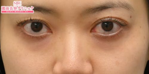 【30女性・目元】目の下の切らないクマ・たるみ（ふくらみ）取り ナチュラル脂肪注射コンデンスリッチ ナチュラル脂肪注射ナノリッチ_before