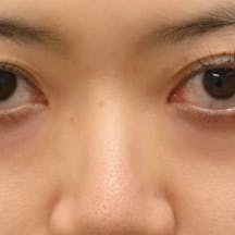 【30女性・目元】目の下の切らないクマ・たるみ(ふくらみ)取り ナチュラル脂肪注射コンデンスリッチ ナチュラル脂肪注射ナノリッチ_before