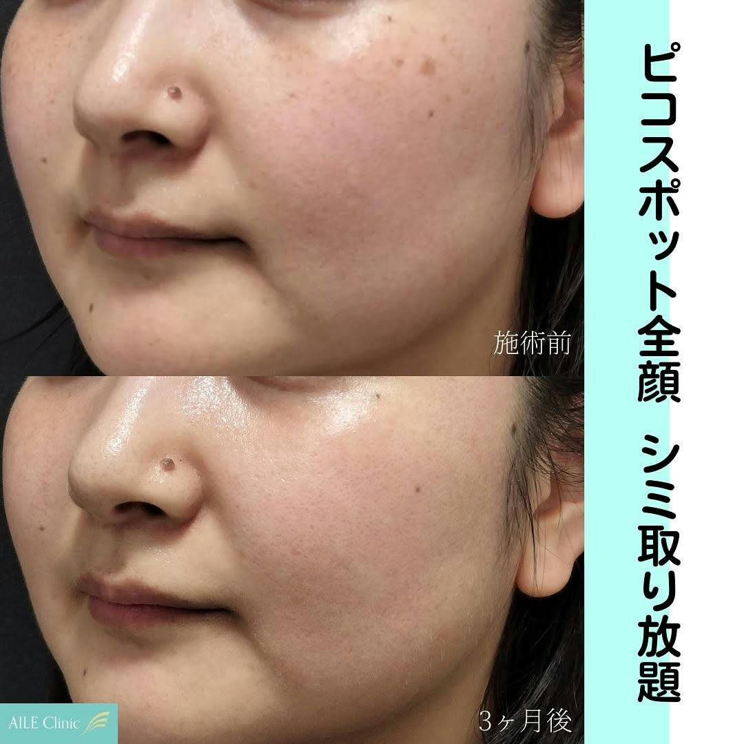 【女性・シミ】ピコスポット全顔_before_aftar