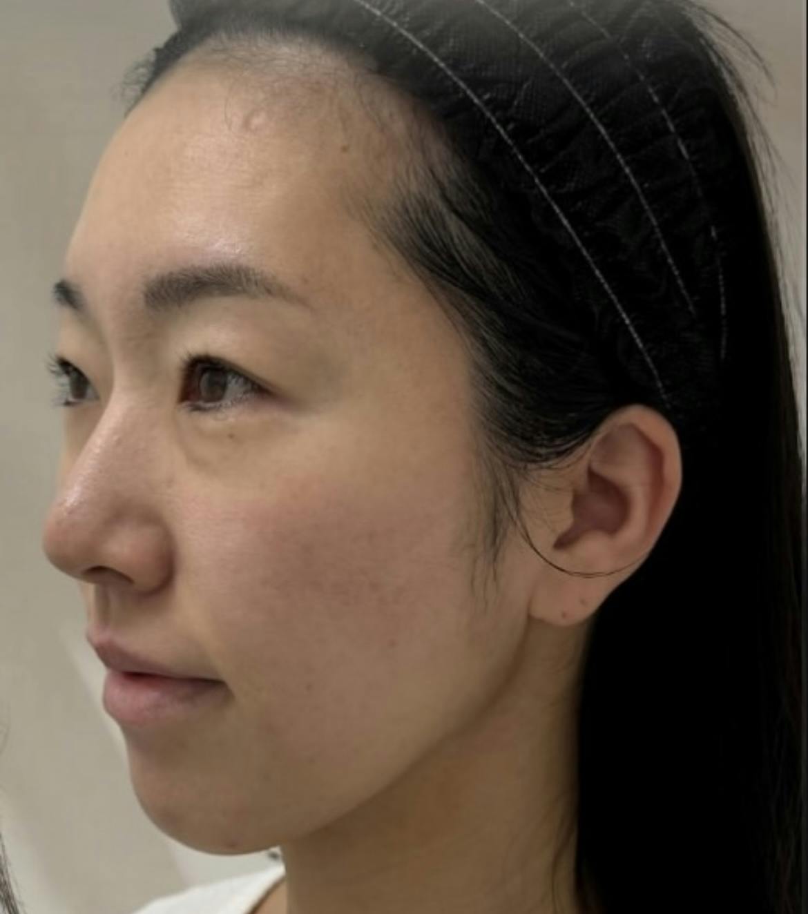 【30代女性・面長解消】ヒアルロン酸_a1