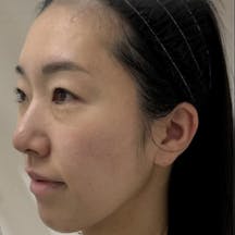 【30代女性・面長解消】ヒアルロン酸_a1