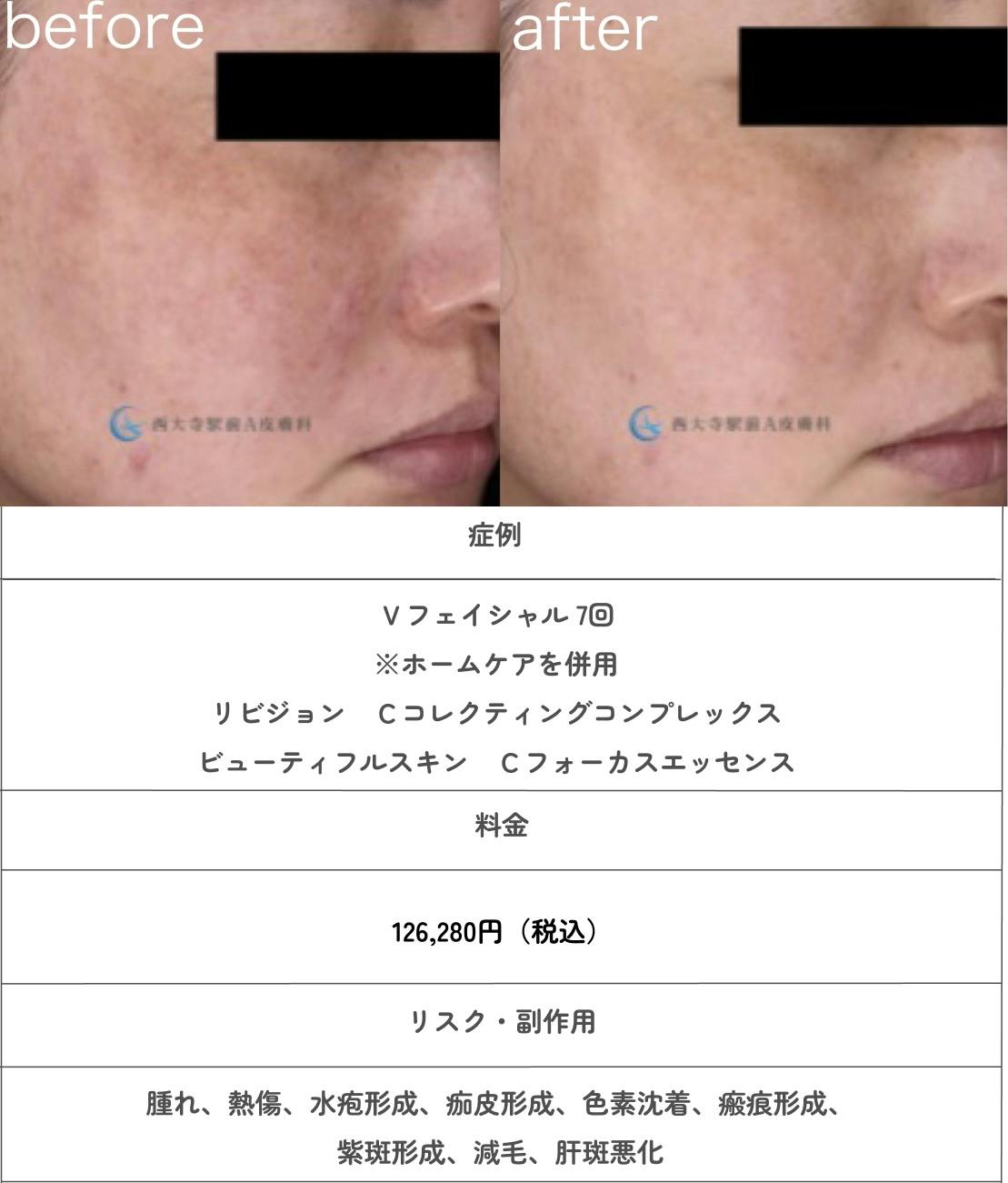 西大寺駅前A皮膚科の赤み治療のbefore/after