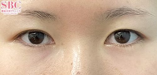 【女性・目元】クイックコスメティーク・ダブルNeo、目頭切開プレミアム、MD式切開法_before