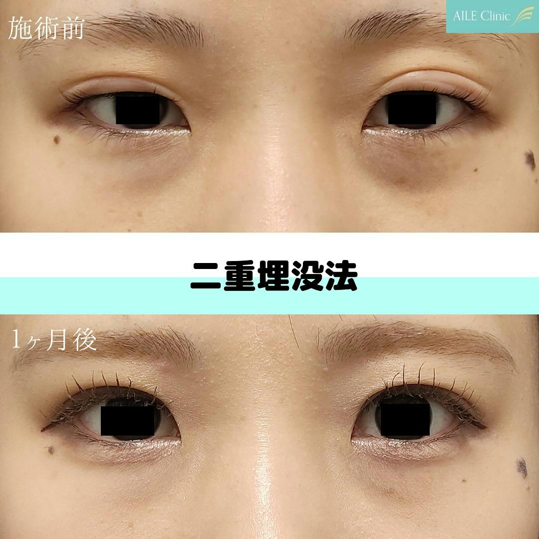 【女性・目元】二重埋没法_before_aftar