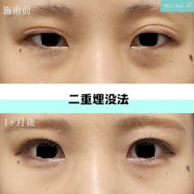 【女性・目元】二重埋没法_before_aftar