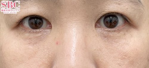 【50代女性・クマ】目の下の切らないクマ・たるみ（ふくらみ）取り ナチュラル脂肪注射コンデンスリッチ ナチュラル脂肪注射ナノリッチ_after