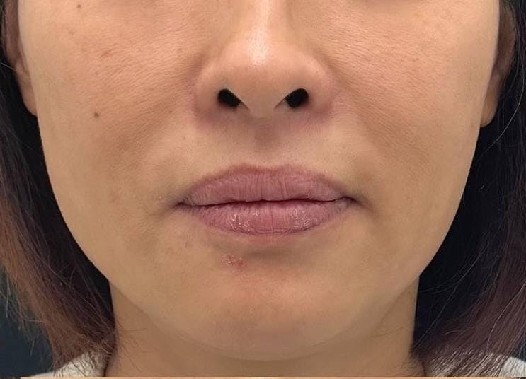 湘南美容クリニック 新宿本院でリフトアップ術：シークレットリフト6本・SBCプリマリフト10本を受けたキムさんの写真