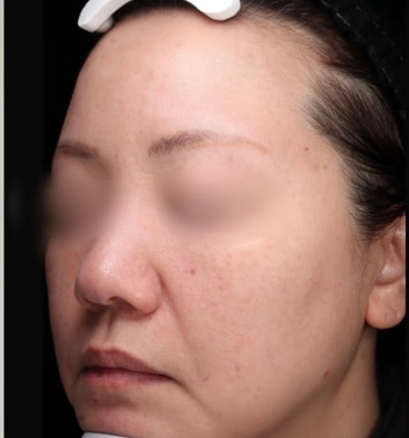 【女性・赤ら顔】メソナj_b1