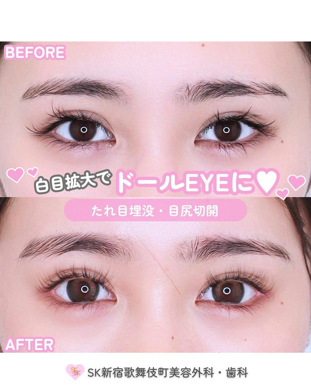 【女性・目元】たれ目埋没・目尻切開_before_aftar